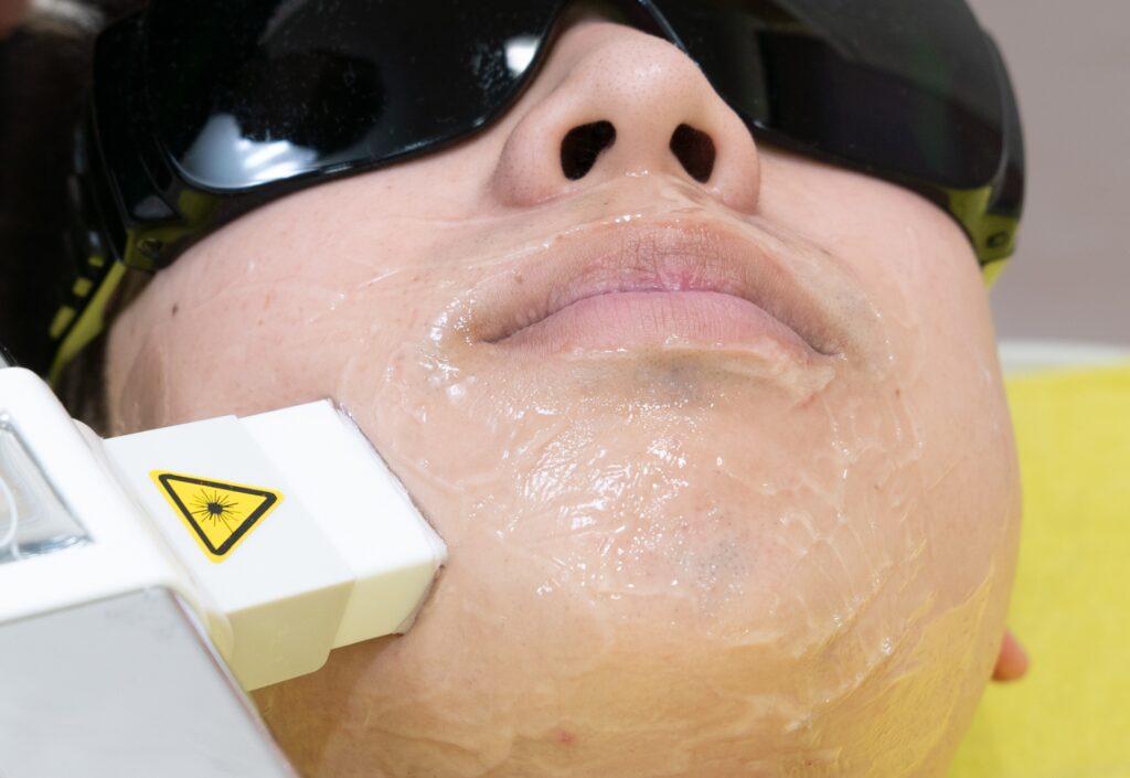 レーザー脱毛(メンズ)施術イメージ