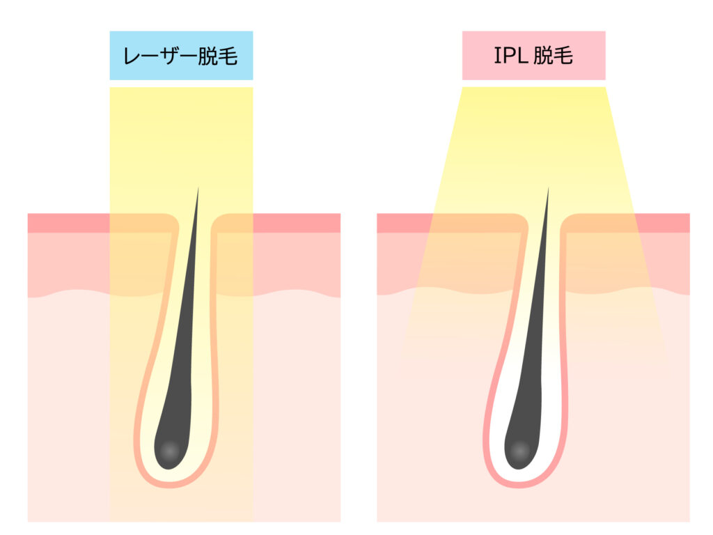 IPL脱毛