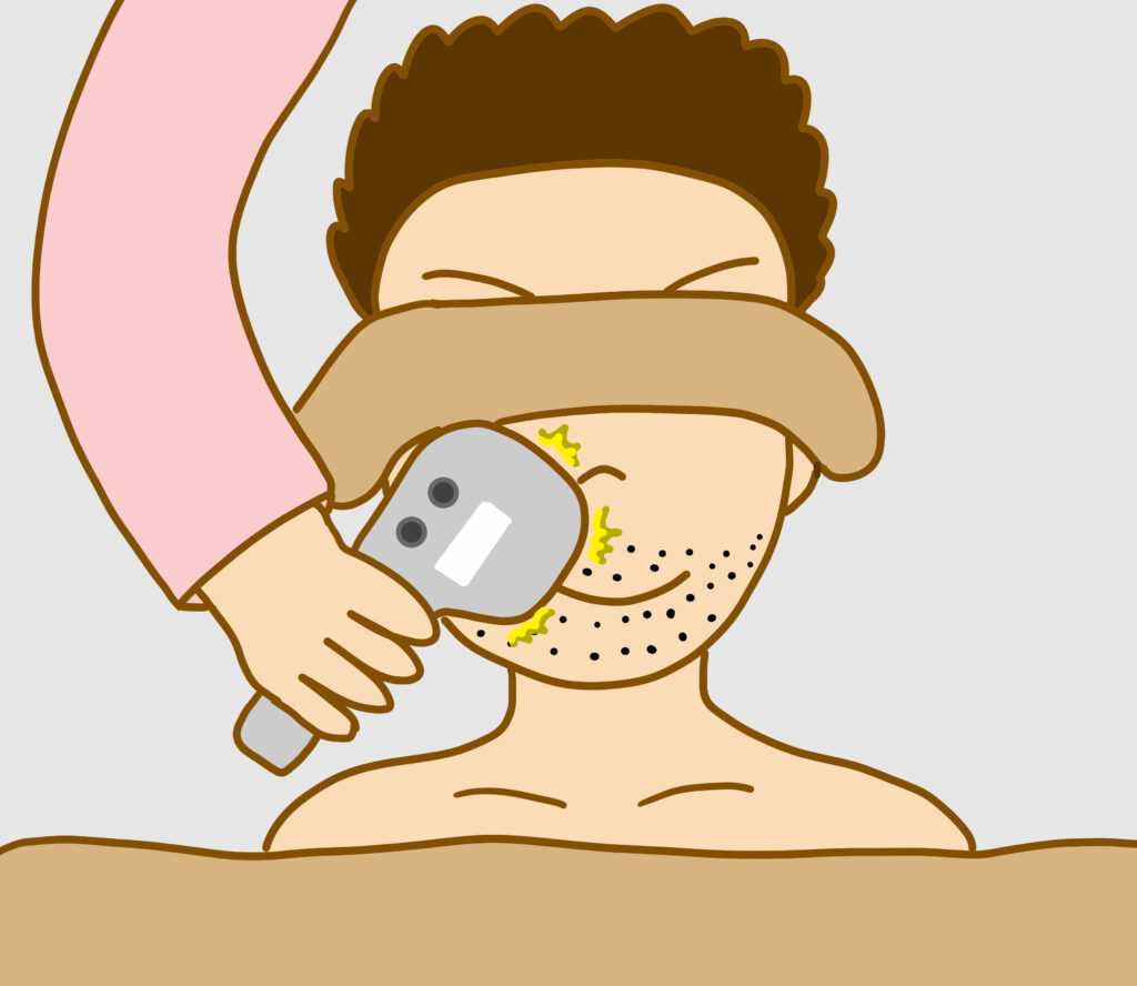 ひげのレーザー脱毛